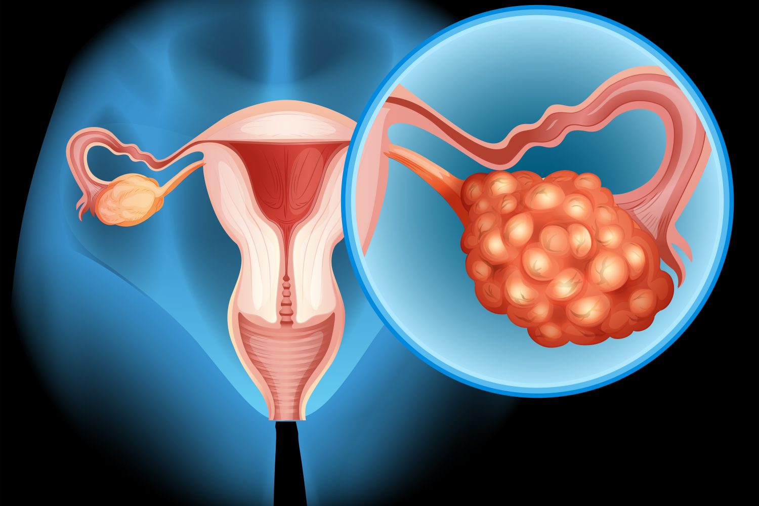 Diagrama de cáncer de ovario en detalle