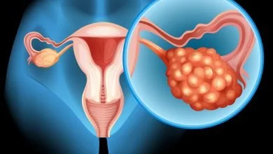 Diagrama de cáncer de ovario en detalle
