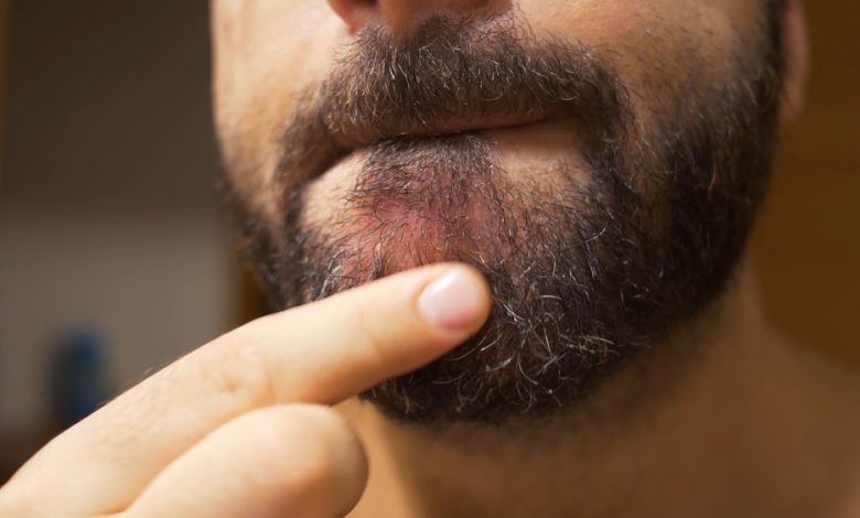 Foliculitis de la barba: así se puede prevenir