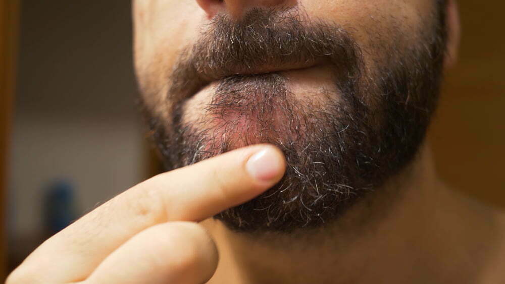 ¡Tenga cuidado! estos son los efectos secundarios de usar minoxidil en ...