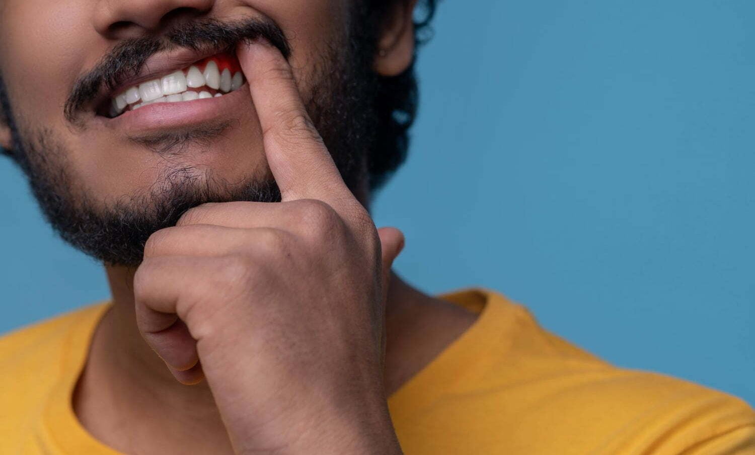 hombre mostrando su encía con gingivitis