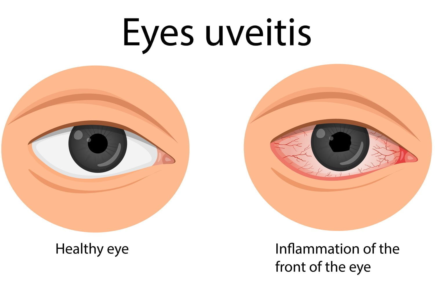 Ilustración de un ojo saludable y uno con uveítis