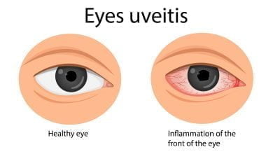 Ilustración de un ojo saludable y uno con uveítis