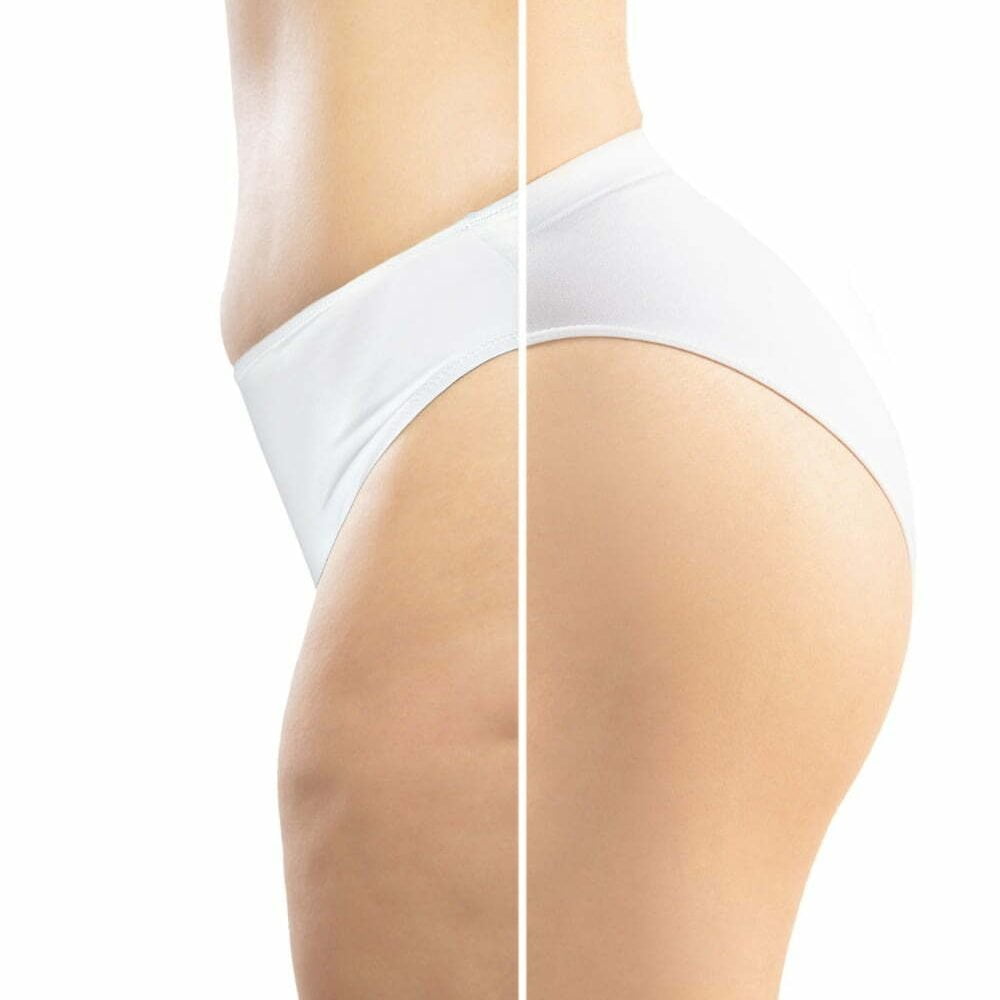 aparición de celulitis en cuerpo de mujer