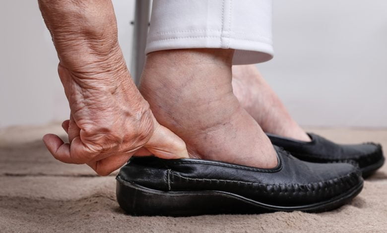 Mujeres mayores hinchadas de pies poniéndose zapatos / hinchazón